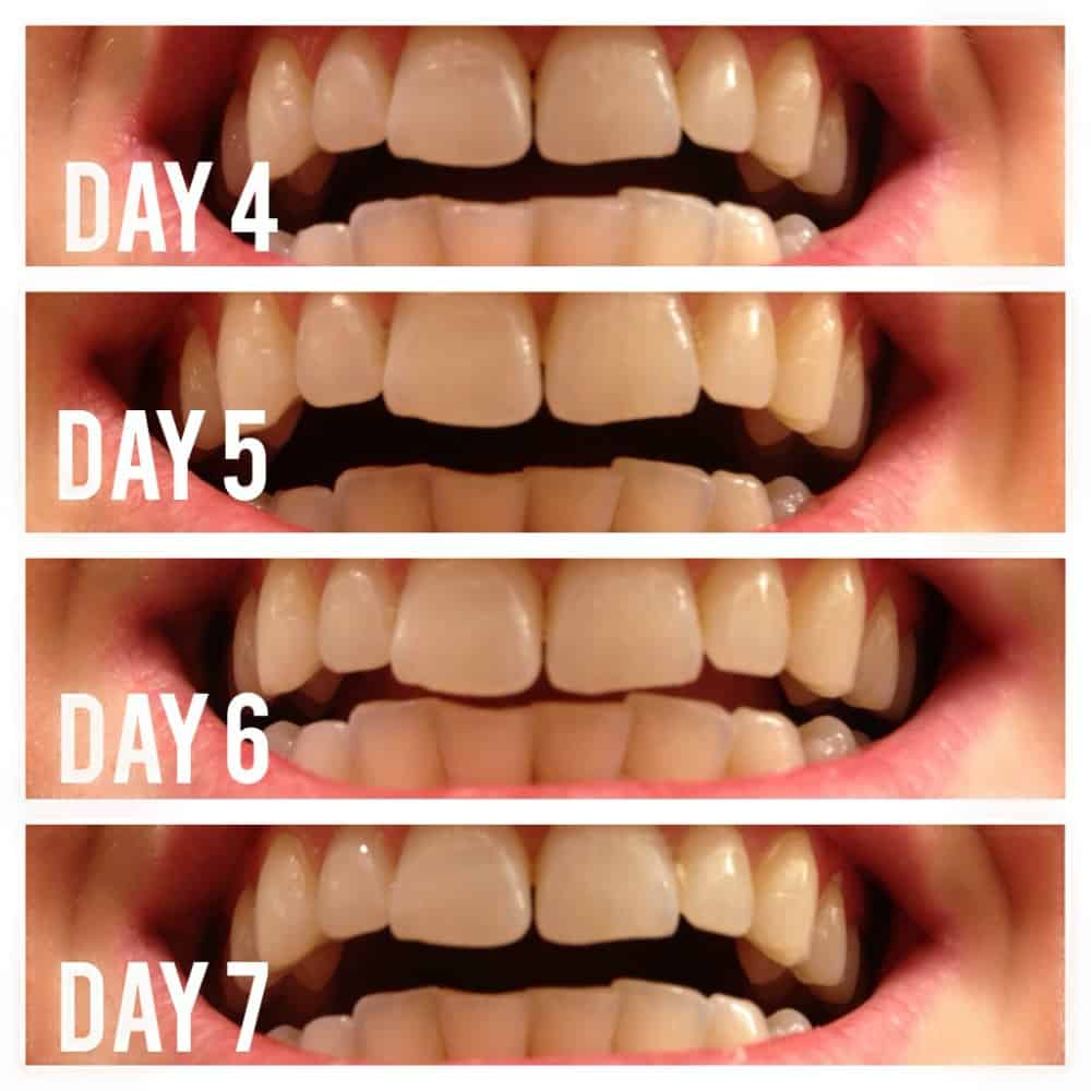 Pin Teeth Whitening Also Known As Tooth Bleaching Is One Of The Most 